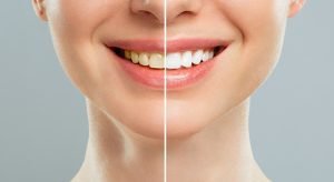 Teeth Whitening treatment