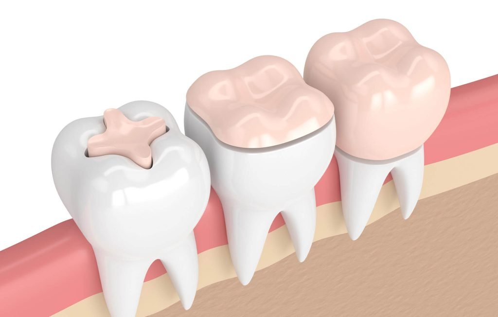 Dental Inlays & Onlays
