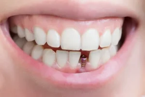 Mini Dental Implants