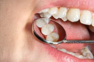 Composite Fillings