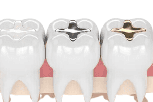 Dental Fillings