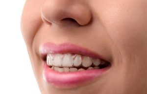 Invisalign