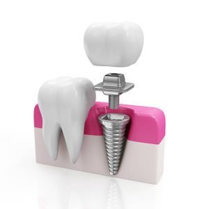 Dental implants