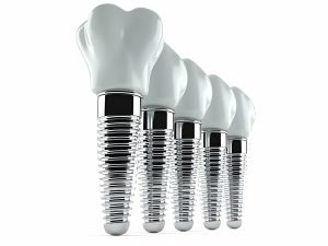 Dental Implants