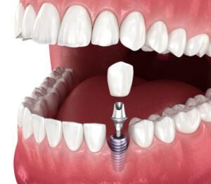 Dental implant Dumfries