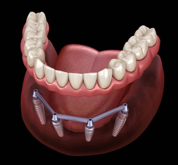 All-on-4 dental implants