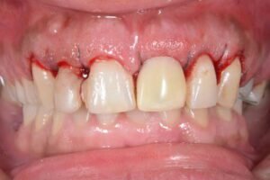 Implants with Receding Gums