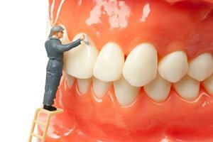 lose your gums around dental implants