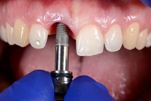 Single Dental Implant