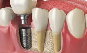 1 Implant Replace 2 Teeth