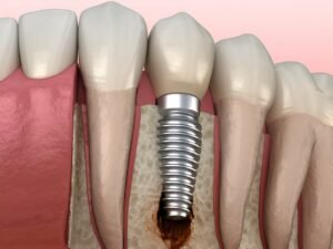 Peri-Implantitis