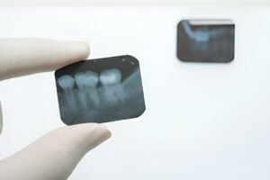 Peri-Implantitis Show Up on an X-ray