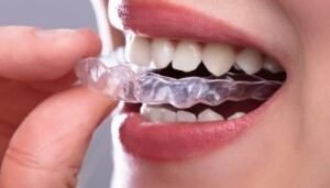 Does NHS Cover Invisalign?