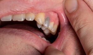 Is a Black Tooth an Emergency?